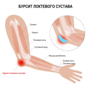 Причины возникновения бурсита